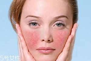 紅血絲用哪種護(hù)膚品？6款大牌全面對抗紅血絲