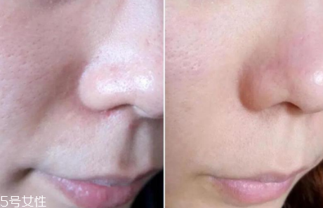 aesop伊索祛痘凝膠怎么樣？一晚還你平滑肌膚