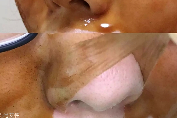 雪花秀撕拉面膜怎么撕出黑頭？這么做才能去黑頭