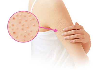 好用且去雞皮膚的身體乳推薦 有雞皮膚要注意 好用且去雞皮膚的身體乳推薦 有雞皮膚要注意