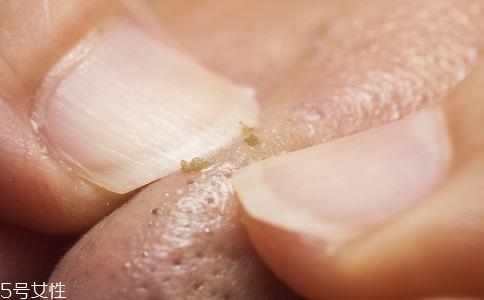 去黑頭用什么最有效？徒手?jǐn)D黑頭容易感染