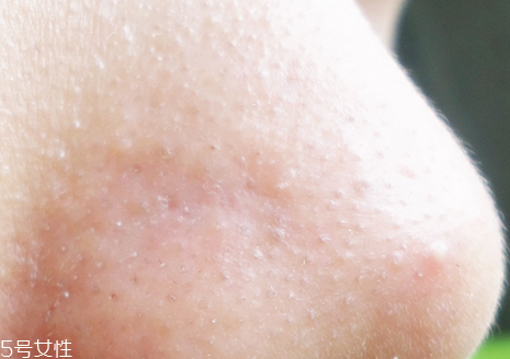 ipsa清潔面膜去黑頭怎么樣 臉上有黑頭怎么去除好 ipsa清潔面膜去黑頭怎么樣 臉上有黑頭怎么去除好