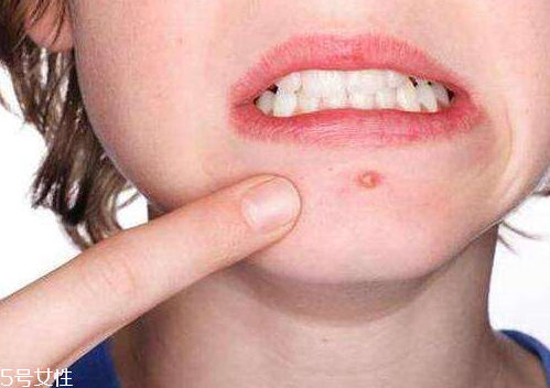 skinb5抗痘護膚片有效果嗎？