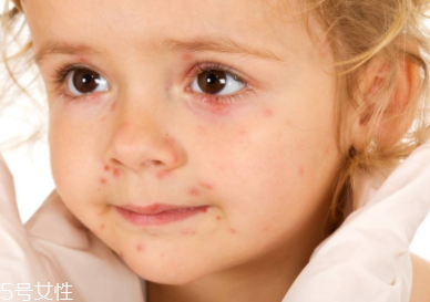 痘印顏色加深是怎么回事？補(bǔ)水還不夠