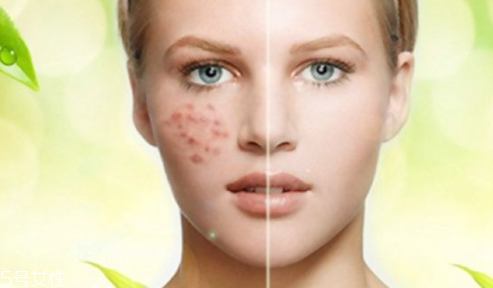 痘印顏色加深是怎么回事？補(bǔ)水還不夠