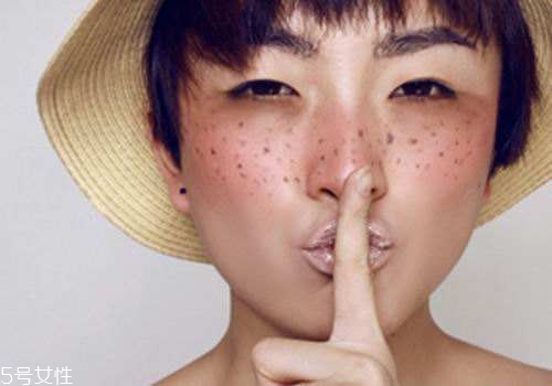 祛斑反彈是什么原因？一定沒注意這4點(diǎn)
