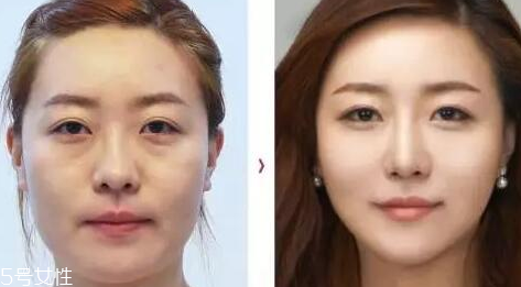 臉上出現(xiàn)三八紋怎么去除 抗老要提前 臉上出現(xiàn)三八紋怎么去除 抗老要提前