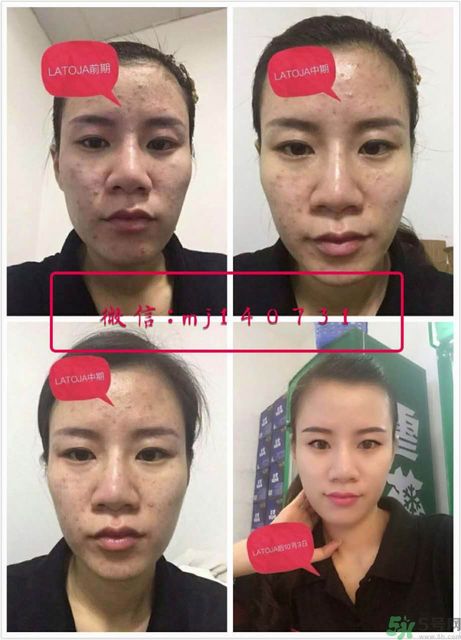 涵曦排毒針效果怎么樣？涵曦新品排毒針安全有副作用嗎？