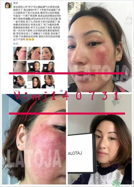 涵曦排毒針效果怎么樣？涵曦新品排毒針安全有副作用嗎？