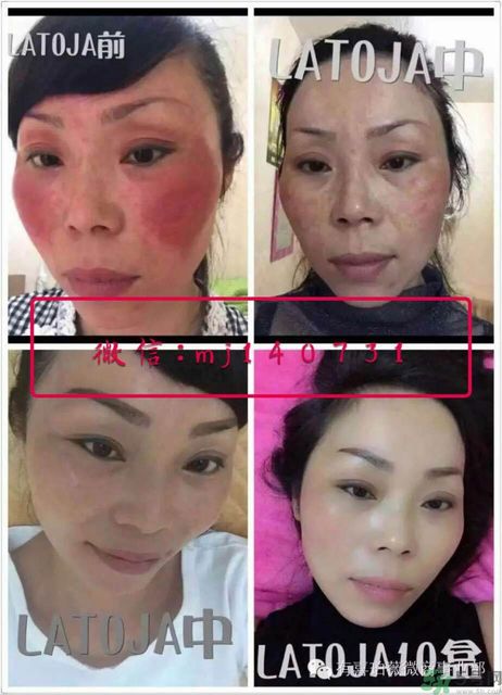 涵曦排毒針效果怎么樣？涵曦新品排毒針安全有副作用嗎？