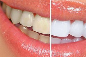 牙貼可以每天用嗎？牙貼多久用一次