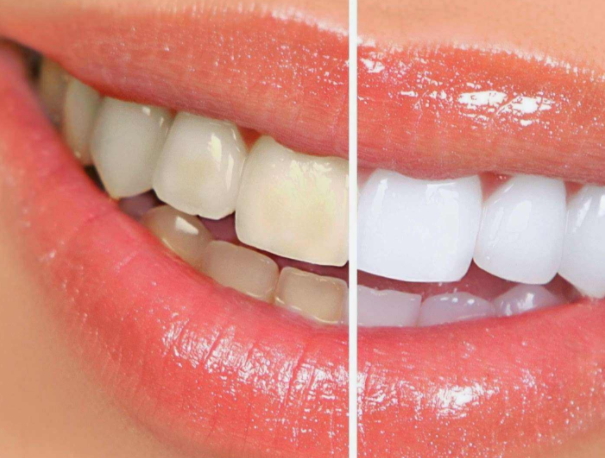 牙貼可以貼著睡覺嗎？牙貼可以過夜嗎