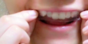 美白牙貼會(huì)反彈嗎？牙貼美白效果持續(xù)多久