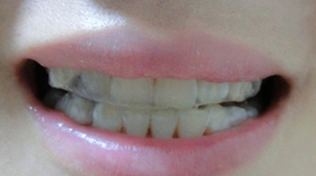 美白牙貼會(huì)反彈嗎？牙貼美白效果持續(xù)多久