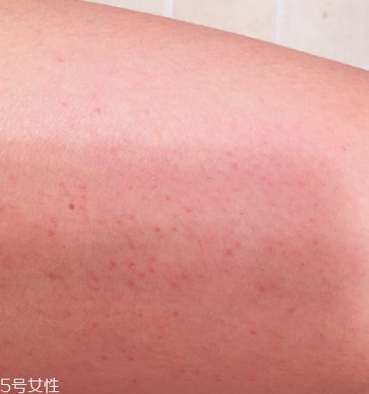 怎么去除雞皮膚 跟你的雞皮膚說再見 怎么去除雞皮膚 跟你的雞皮膚說再見