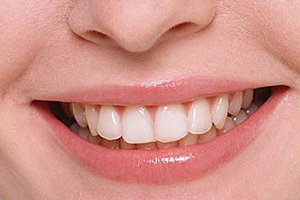 洗牙粉能把牙洗白嗎？洗牙粉有效嗎