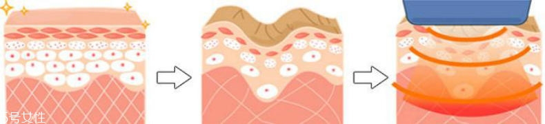 干性肌膚怎么抗皺 干性肌抗皺注意三點(diǎn) 干性肌膚怎么抗皺 干性肌抗皺注意三點(diǎn)