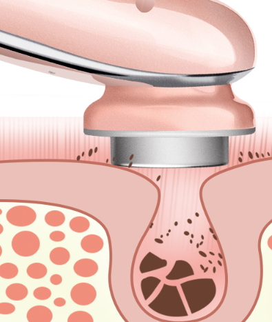 導出儀對皮膚的傷害 導出儀的副作用 導出儀對皮膚的傷害 導出儀的副作用