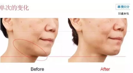 雅萌射頻美容儀防水嗎？雅萌Bloom射頻美容儀可以水洗嗎