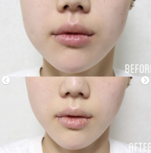 dodo label隱形瘦臉貼好用嗎 韓國ins網(wǎng)紅爆款瘦臉神器 dodo label隱形瘦臉貼好用嗎 韓國ins網(wǎng)紅爆款瘦臉神器