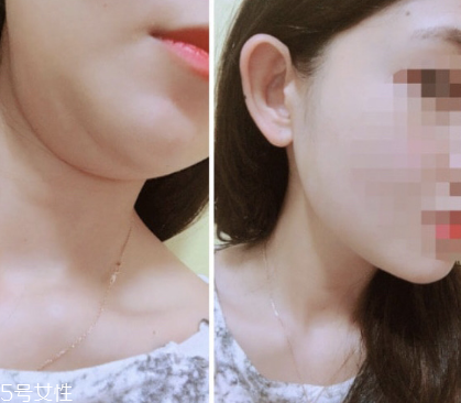 dodo label隱形瘦臉貼好用嗎 韓國ins網(wǎng)紅爆款瘦臉神器 dodo label隱形瘦臉貼好用嗎 韓國ins網(wǎng)紅爆款瘦臉神器