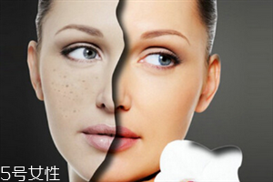 太陽穴長痘痘是什么原因 怎么避免長痘痘 太陽穴長痘痘是什么原因 怎么避免長痘痘