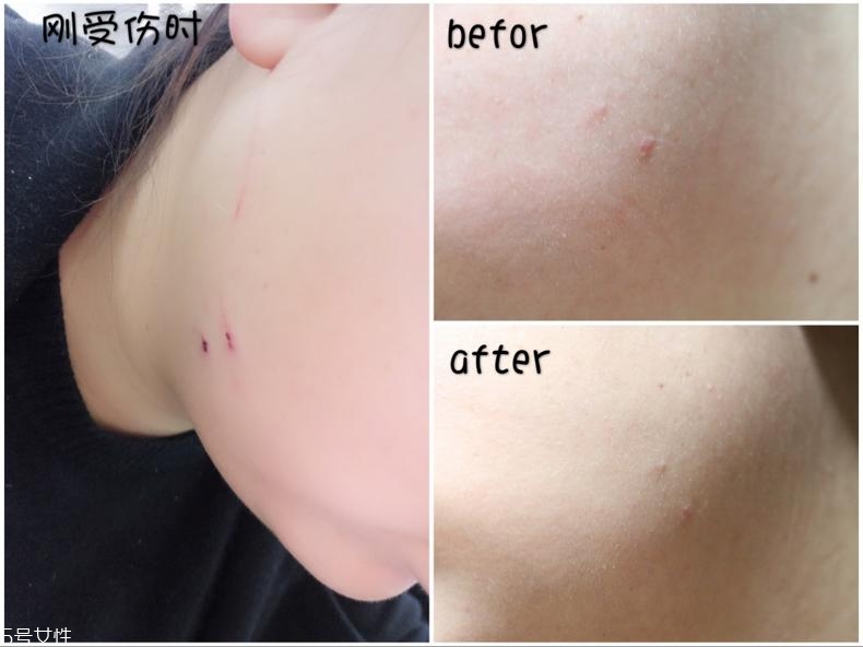 舒痕硅凝膠去疤有效嗎 舒痕硅凝膠15g能用多久 舒痕硅凝膠去疤有效嗎 舒痕硅凝膠15g能用多久