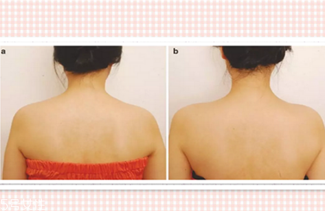 瘦肩針可以緩解疲勞嗎？瘦肩針對緩解疲勞有用嗎