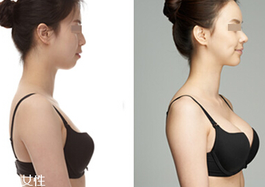 注射豐胸的危害有哪些 自體脂肪豐胸后怎樣護(hù)理效果最好 注射豐胸的危害有哪些 自體脂肪豐胸后怎樣護(hù)理效果最好