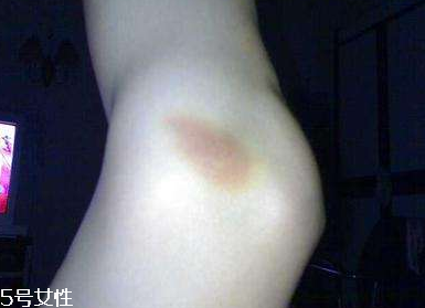 小林制藥去淤青膏怎么樣？小林制藥去淤青膏好用嗎？