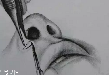 鼻翼外切多久消腫？鼻翼外切消腫時(shí)間要多長(zhǎng)？