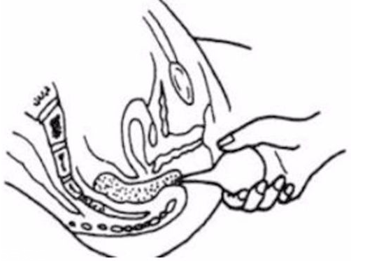 開塞露躺著還是蹲著用？開塞露使用姿勢(shì)