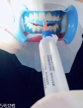 冷光美白會反彈嗎？冷光美白心得