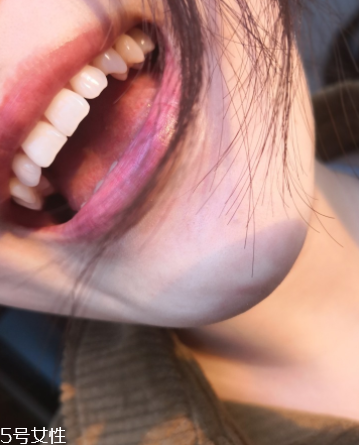 超聲波潔牙牙齒會變白嗎？超聲波潔牙心得