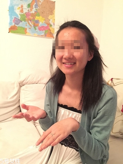 dermaroller玻尿酸好用嗎 dermaroller玻尿酸使用方法 dermaroller玻尿酸好用嗎 dermaroller玻尿酸使用方法