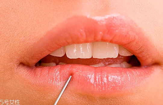 玻尿酸豐唇一周不變軟是什么原因 玻尿酸豐唇后要注意 玻尿酸豐唇一周不變軟是什么原因 玻尿酸豐唇后要注意