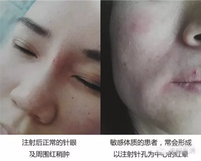 填充法令紋能維持多久 填充法令紋保持時(shí)間 填充法令紋能維持多久 填充法令紋保持時(shí)間