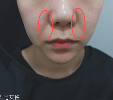 填充法令紋能維持多久 填充法令紋保持時(shí)間 填充法令紋能維持多久 填充法令紋保持時(shí)間