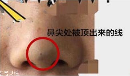 線雕隆鼻存在哪些危害 線雕隆鼻有危害嗎 線雕隆鼻存在哪些危害 線雕隆鼻有危害嗎
