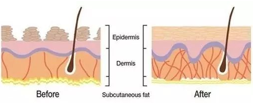 線雕提升能維持多久 線雕技術(shù)優(yōu)勢 線雕提升能維持多久 線雕技術(shù)優(yōu)勢