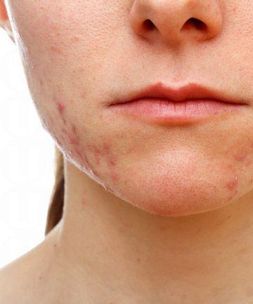 下巴上長痘怎么治 5個非藥膏方法 下巴上長痘怎么治 5個非藥膏方法