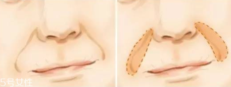 鼻唇溝填充用什么方法 鼻唇溝填充顯年輕嗎 鼻唇溝填充用什么方法 鼻唇溝填充顯年輕嗎
