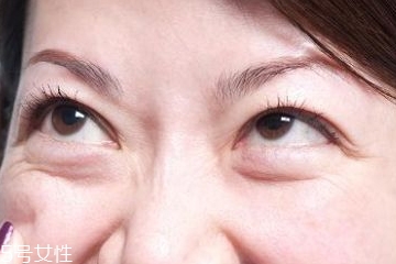 去眼袋手術(shù)幾天拆線好 去眼袋最永久的方法 去眼袋手術(shù)幾天拆線好 去眼袋最永久的方法