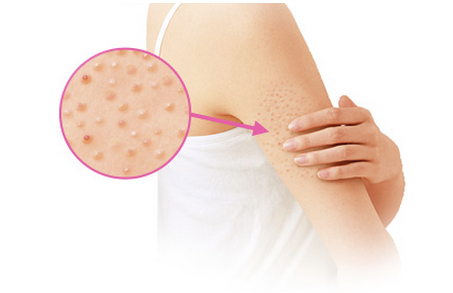 雞皮膚怎么治療小偏方 治療雞皮膚偏方 雞皮膚怎么治療小偏方 治療雞皮膚偏方