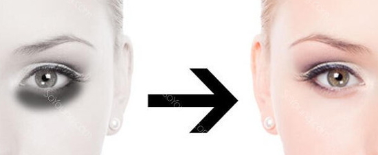 激光去黑眼圈多久恢復(fù)？激光除黑眼圈多久見效