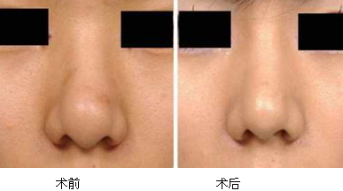 縮鼻手術(shù)多久恢復(fù)？縮鼻手術(shù)傷口才會好