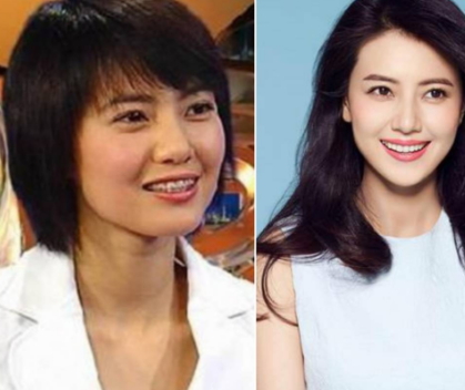 牙齒矯正會(huì)改變臉型嗎？矯正牙齒臉型變化圖