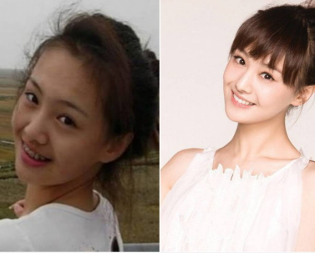 牙齒矯正會(huì)改變臉型嗎？矯正牙齒臉型變化圖