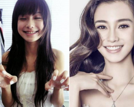 牙齒矯正會(huì)改變臉型嗎？矯正牙齒臉型變化圖