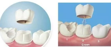 美容冠多少錢一顆？美容冠矯正費(fèi)用